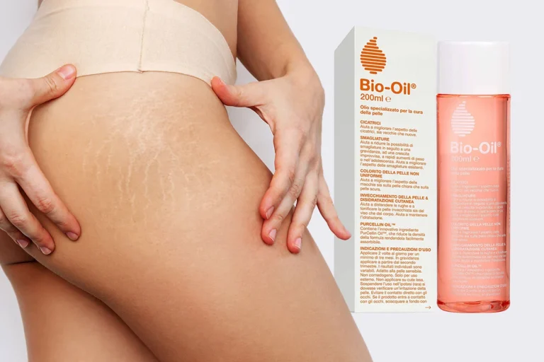 Immagine con smagliature con a fianco il prodotto per recensione Bio oil