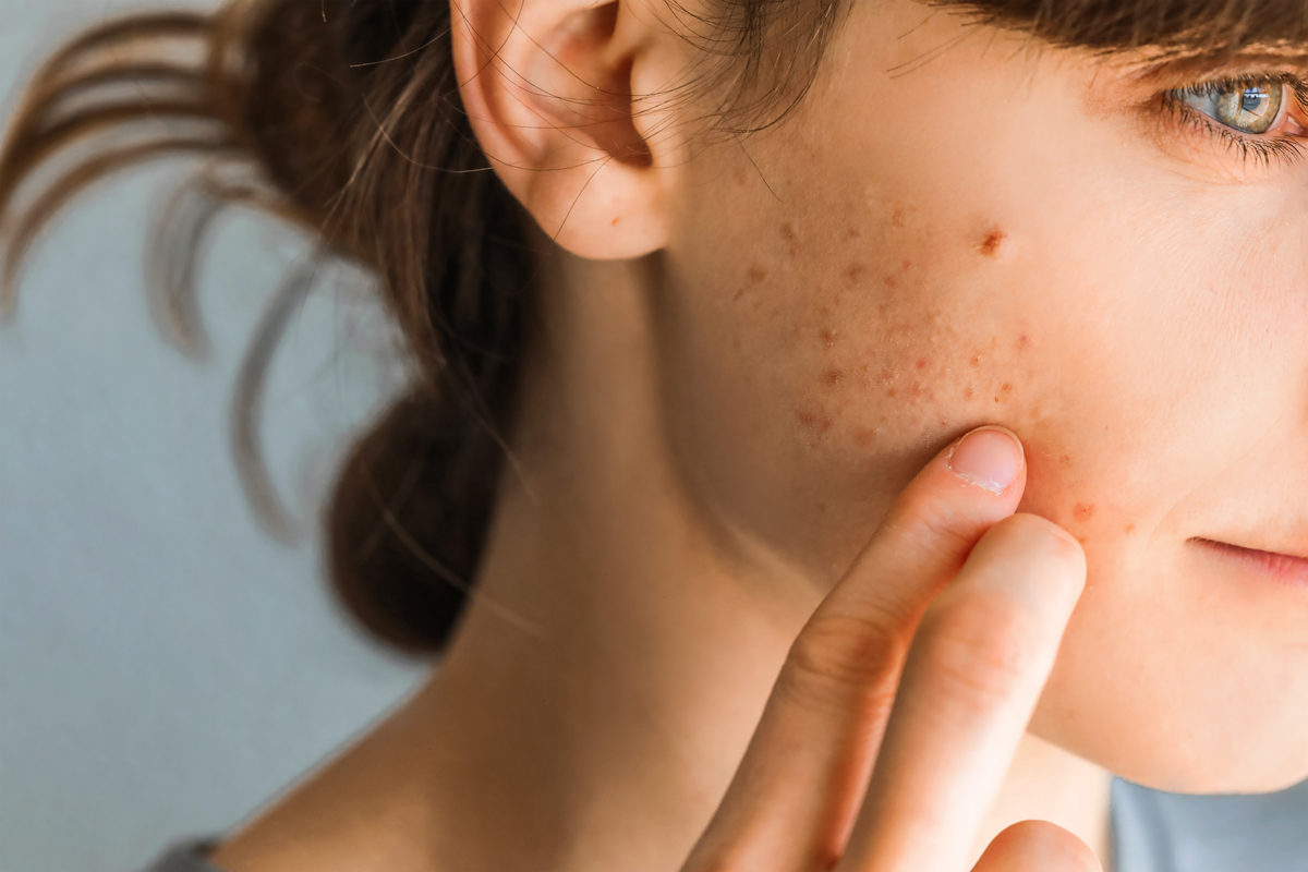 Skin care routine per adolescenti